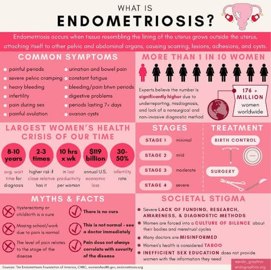 An informative infographic on endometriosis.