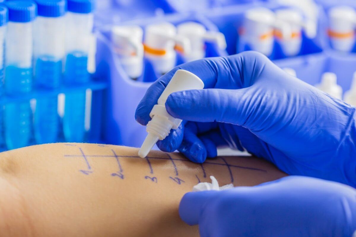 A healthcare professional, possibly the best allergist in Metro Manila, wearing blue gloves places drops of liquid onto marked areas of a patient's forearm for an allergy skin test. In the background, vials of blue liquid are organized in a tray. The patient's forearm is marked with a grid of lines and numbers.