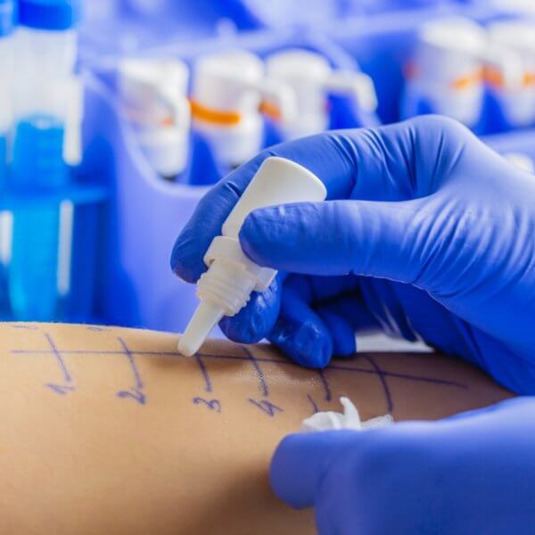 A healthcare professional, possibly the best allergist in Metro Manila, wearing blue gloves places drops of liquid onto marked areas of a patient's forearm for an allergy skin test. In the background, vials of blue liquid are organized in a tray. The patient's forearm is marked with a grid of lines and numbers.