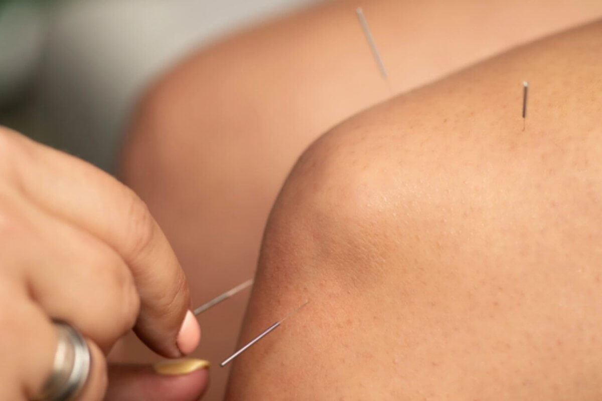 Close-up of an acupuncture session focusing on a person's arm. Thin, metallic needles are inserted into the skin at various points. A practitioner's hand, adorned with a silver ring, is making adjustments to one of the needles with focused precision—an effective therapy practiced widely in Metro Manila.